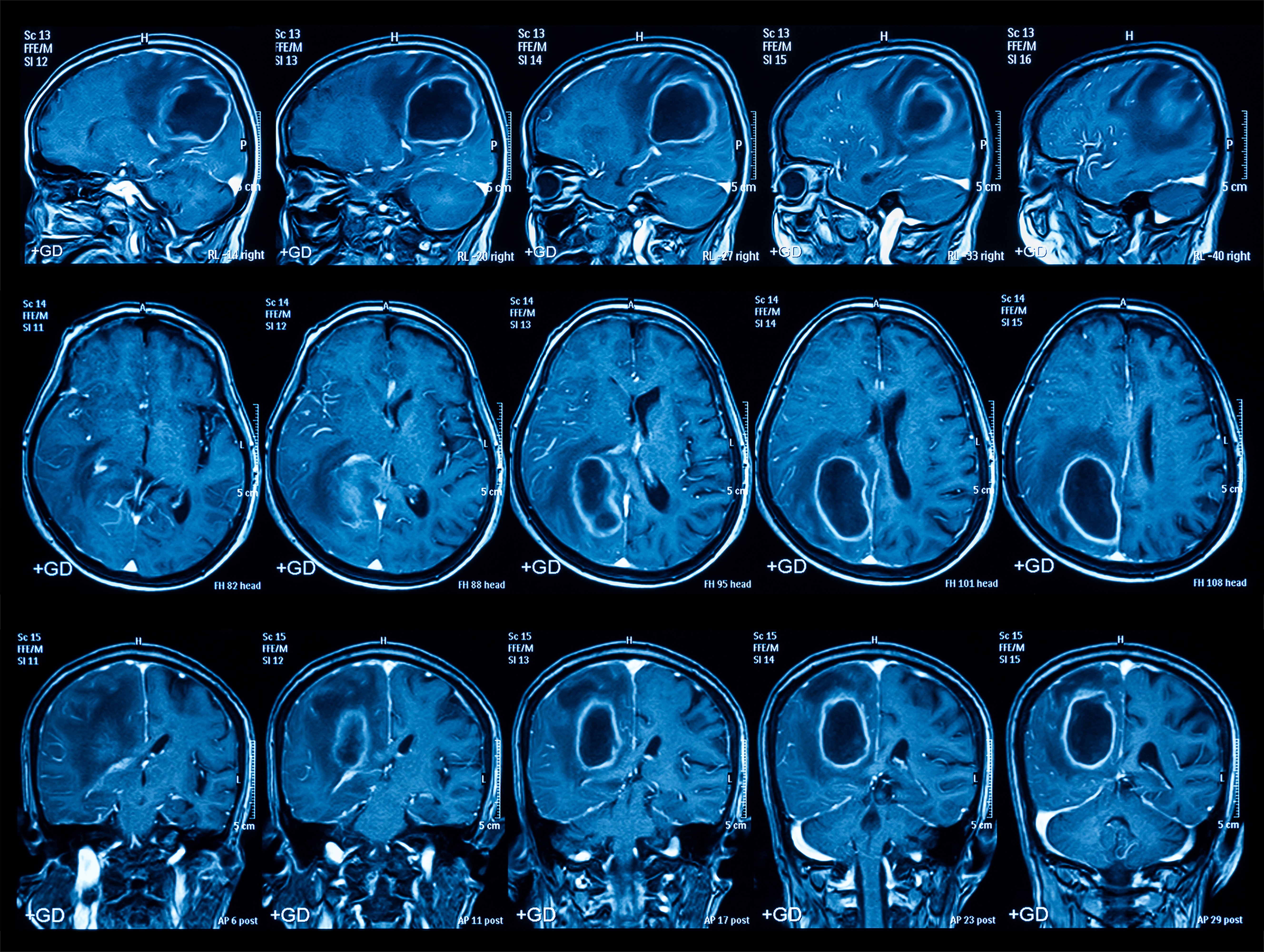 Кт головы стоя. Опухоль головного мозга снимок мрт. Опухоли головного мозга MRT. Кт томограмма головного мозга. Снимки мрт головного мозга с опухолью.